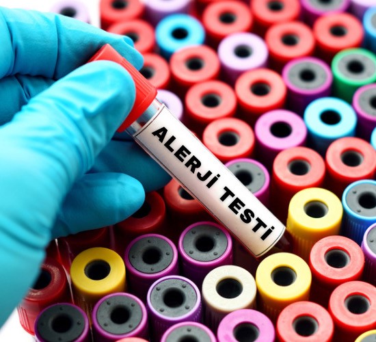 Alerji Testi